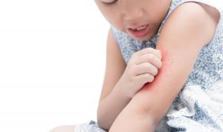 为什么有些人招蚊子 为什么有些人招蚊子